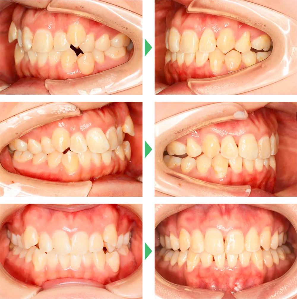 矯正歯科ビフォーアフター　成人