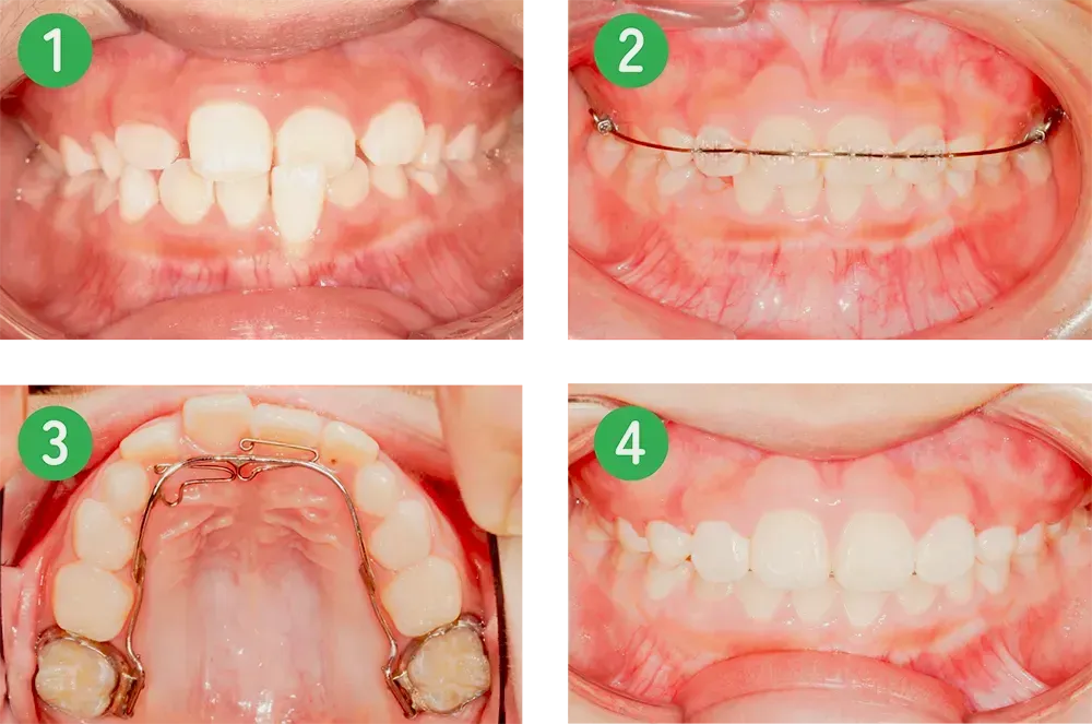 矯正歯科ビフォーアフター　子供