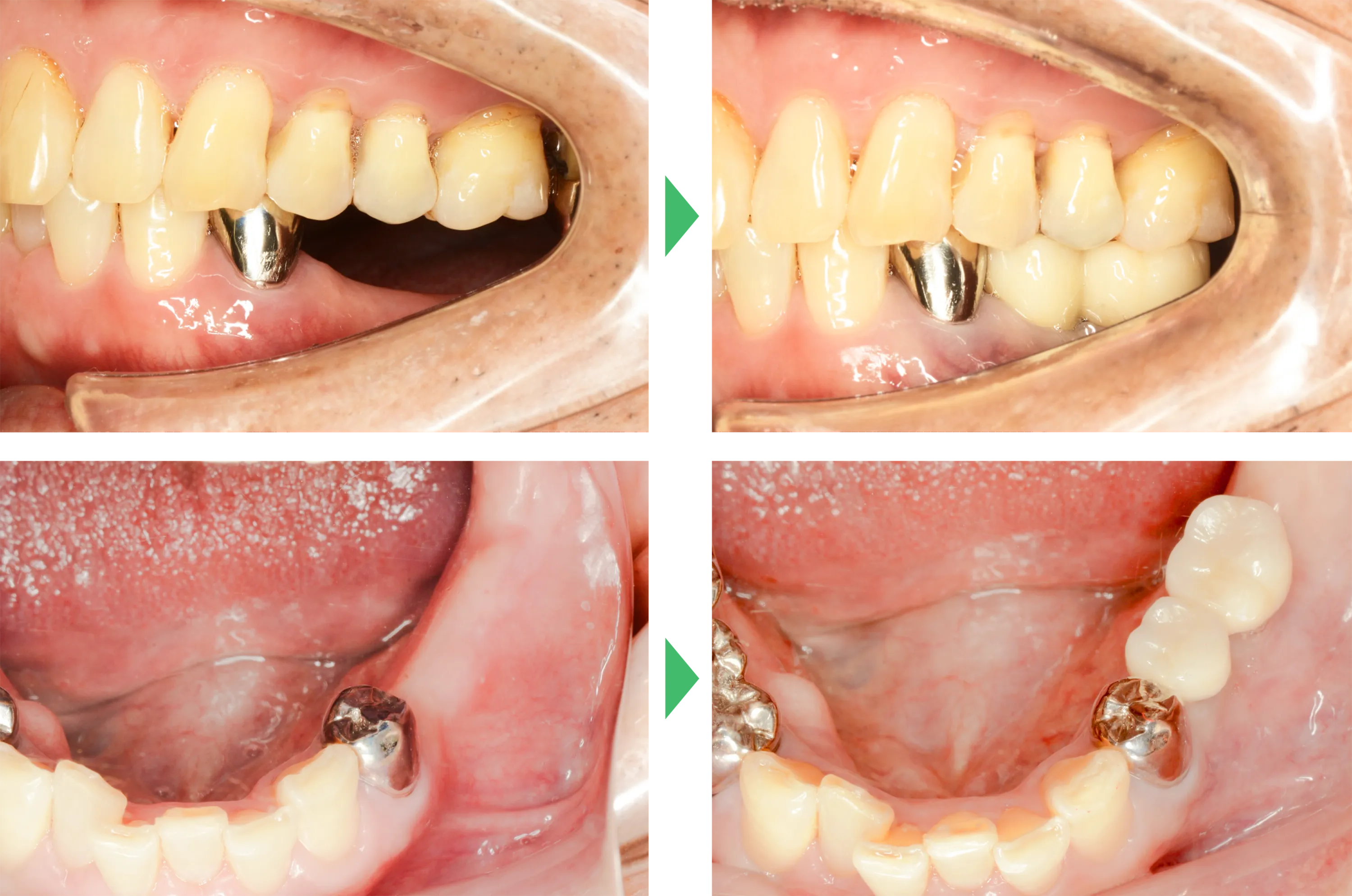 インプラント処置前と処置後